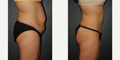 Case 2645 - 28 year old woman treated with Tummy Tuck