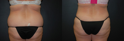 Case 2646 - Woman treated with Tummy Tuck