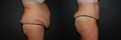 Case 2647 - Woman treated with Tummy Tuck