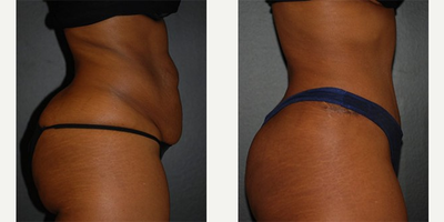 Case 2649 - Woman treated with Tummy Tuck