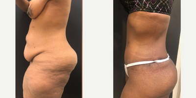 Case 2650 - 45-54 year old woman treated with Tummy Tuck