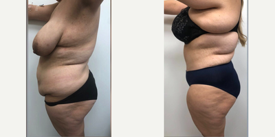 Case 2651 - 45-54 year old woman treated with Tummy Tuck