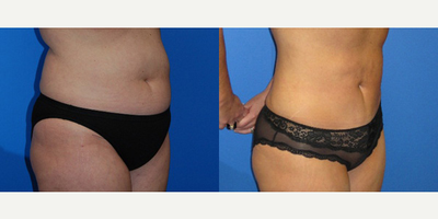 Case 2666 - Woman treated with Tummy Tuck