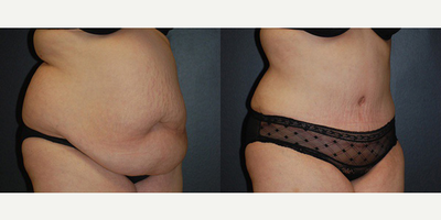 Case 2667 - Woman treated with Tummy Tuck
