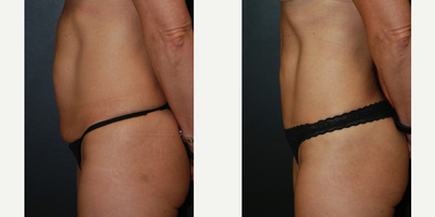 Case 2668 - Woman treated with Tummy Tuck, Vaser Liposuction