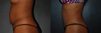 Case 2669 - Woman treated with Tummy Tuck