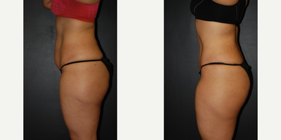 Case 2670 - Woman treated with Tummy Tuck