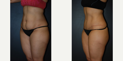 Case 2671 - Woman treated with Tummy Tuck