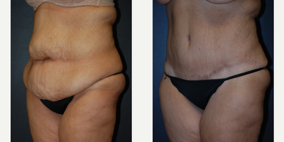 Case 2672 - Woman treated with Tummy Tuck