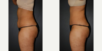 Case 2673 - Woman treated with Tummy Tuck