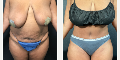 Case 268 - Woman treated with Tummy Tuck