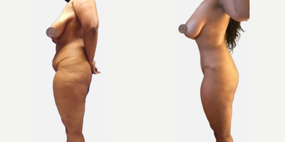 Case 2689 - Tummy Tuck