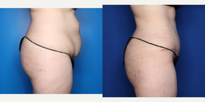 Case 2690 - 35-44 year old woman treated with Tummy Tuck