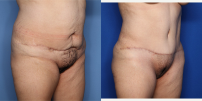 Case 2691 - 35-44 year old woman treated with Tummy Tuck