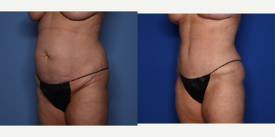 Case 2692 - 45-54 year old woman treated with Tummy Tuck