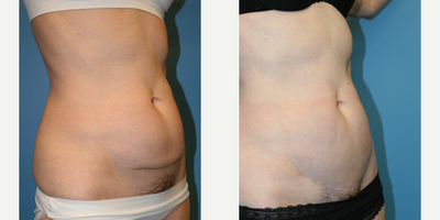 Case 2693 - Woman treated with Tummy Tuck