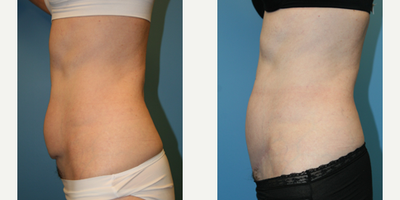 Case 2694 - Woman treated with Tummy Tuck