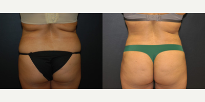 Case 2695 - 40 year old woman treated with Tummy Tuck