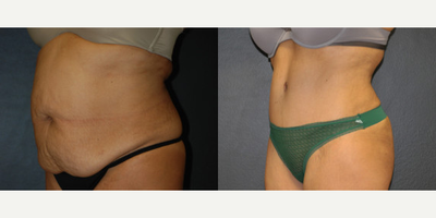 Case 2696 - 40 year old woman treated with Tummy Tuck