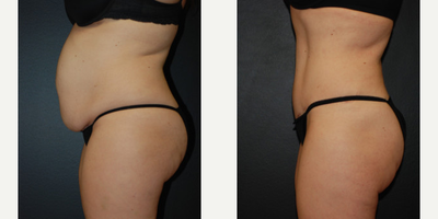 Case 2697 - 40 year old woman treated with Tummy Tuck