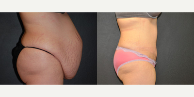Case 2698 - Woman treated with Tummy Tuck