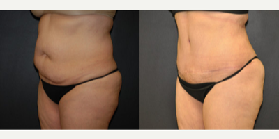 Case 2699 - Woman treated with Tummy Tuck