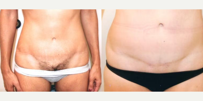 Case 27 - Woman treated with Tummy Tuck
