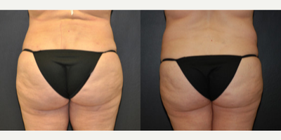 Case 2700 - Woman treated with Tummy Tuck