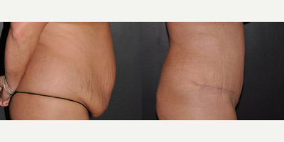 Case 2702 - Woman treated with Tummy Tuck