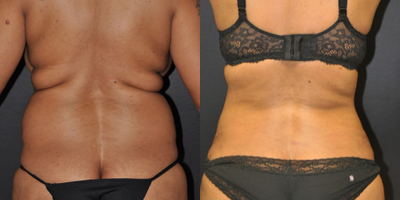 Case 2703 - Woman treated with Tummy Tuck