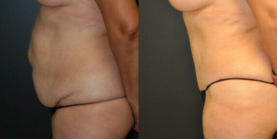 Case 2704 - 45-54 year old woman treated with Tummy Tuck