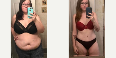 Case 271 - Woman treated with Tummy Tuck