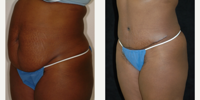Case 2715 - 25-34 year old woman treated with Tummy Tuck