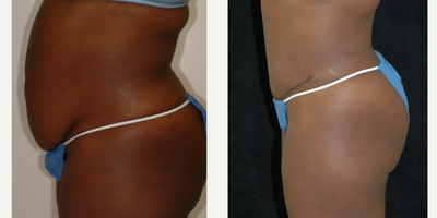 Case 2716 - 25-34 year old woman treated with Tummy Tuck