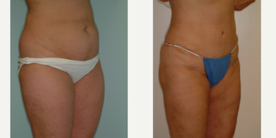 Case 2717 - 25-34 year old woman treated with Tummy Tuck
