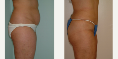 Case 2718 - 25-34 year old woman treated with Tummy Tuck