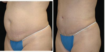 Case 2719 - 25-34 year old woman treated with Tummy Tuck