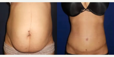 Case 272 - Woman treated with Tummy Tuck