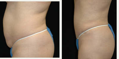 Case 2720 - 25-34 year old woman treated with Tummy Tuck