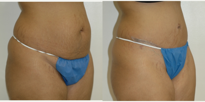 Case 2721 - 25-34 year old woman treated with Tummy Tuck