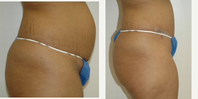 Case 2722 - 25-34 year old woman treated with Tummy Tuck