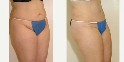 Case 2723 - 25-34 year old woman treated with Tummy Tuck
