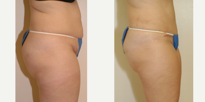 Case 2724 - 25-34 year old woman treated with Tummy Tuck