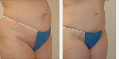 Case 2725 - 35-44 year old woman treated with Tummy Tuck