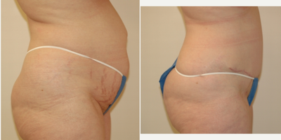 Case 2726 - 35-44 year old woman treated with Tummy Tuck
