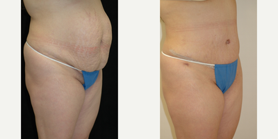 Case 2727 - 25-34 year old woman treated with Tummy Tuck