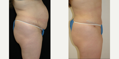 Case 2728 - 25-34 year old woman treated with Tummy Tuck