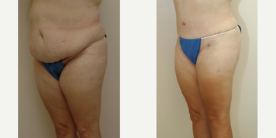 Case 2729 - 35-44 year old woman treated with Tummy Tuck