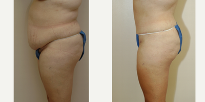Case 2730 - 35-44 year old woman treated with Tummy Tuck