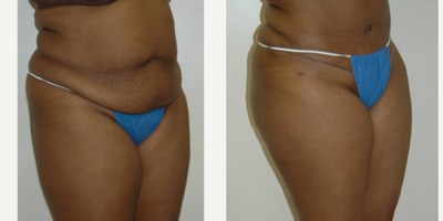 Case 2731 - 18-24 year old woman treated with Tummy Tuck